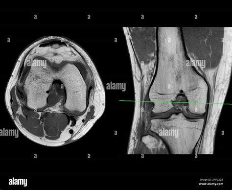 Mri And Knee
