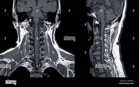 Mri C Spine