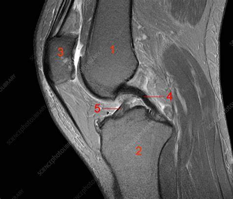 Mri Knee Joint