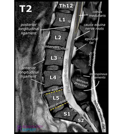 Mri Of The L Spine