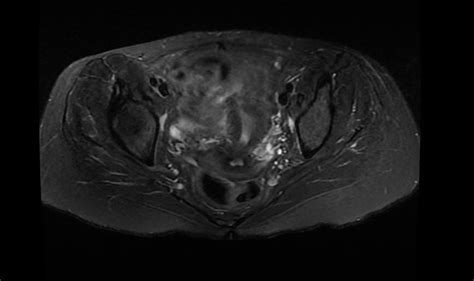 Mri Pelvis Without Contrast