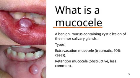Mucocele On Lip