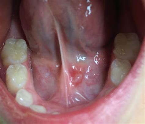 Mucoceles In Mouth