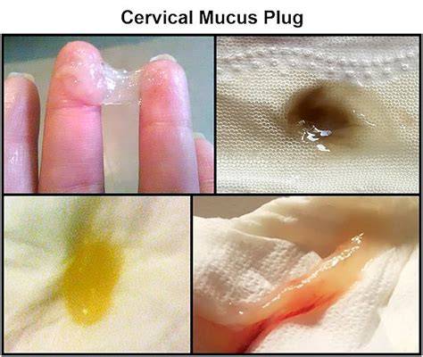 Mucus Plug Versus Discharge