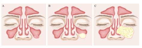 Mucus Retention Cyst Sinus