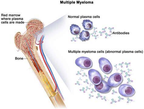 Multi Myeloma Test