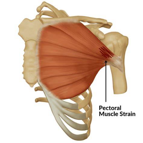 Muscle Strain In Pectoral