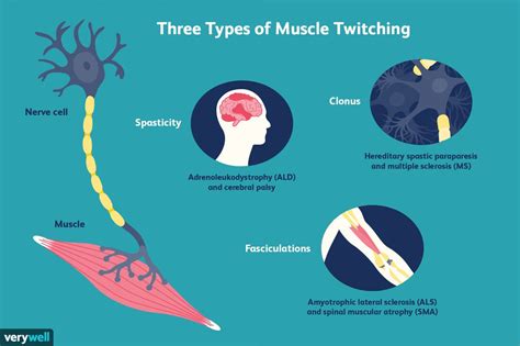 Muscle Twitches Abdomen