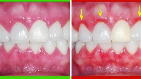 My Gums Are Puffy