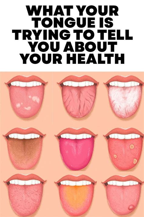 My Tongue Hurts
