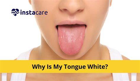 My Tongue Is White