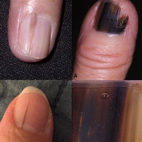 Nail Melanoma Images
