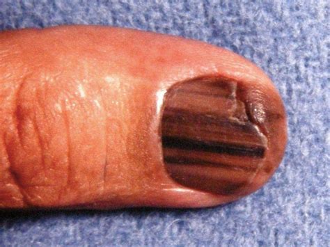 Nail Melanoma Pictures