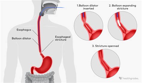 Narrowing Of The Esophagus