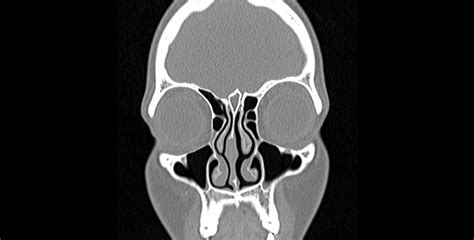 Nasal Ct Scan