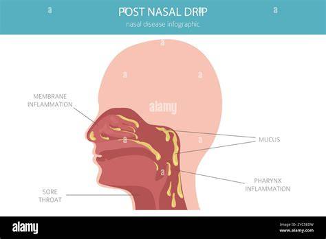 Nasal Drip Throat Pain