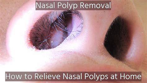Nasal Polyp Removal