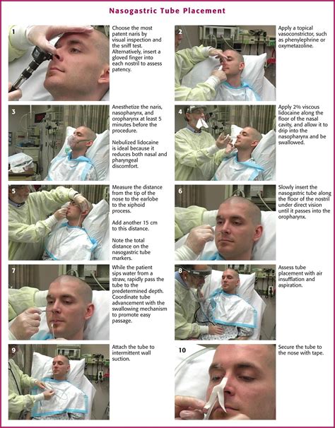 Nasogastric Tube Placement