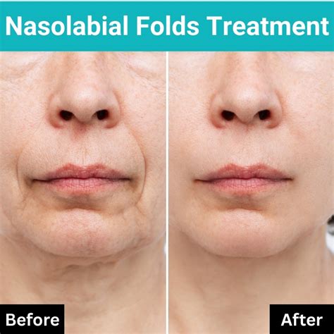 Nasolabial Fold Treatment