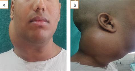 Neck Is Swelling