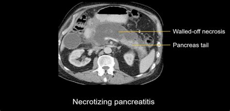 Necrotizing Pancreatitis Causes