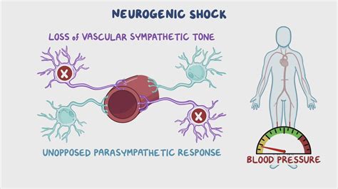 Neurogenic Shock Hypotension