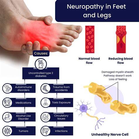 Neuropathy In The Foot Symptoms