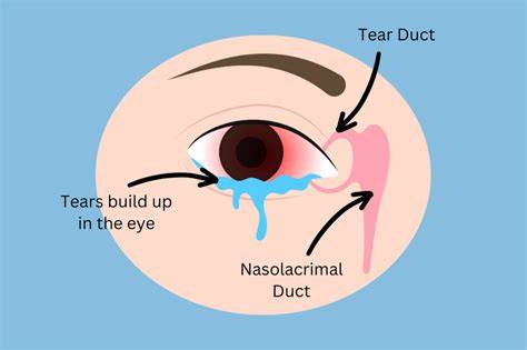 Newborn Clogged Tear Duct