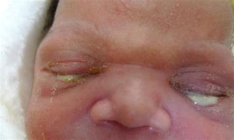 Newborn Eye Boogers