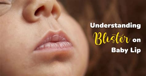 Newborn Nursing Blisters Lips