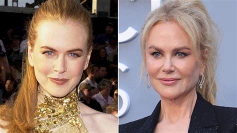 Nicole Kidman Surgery Face