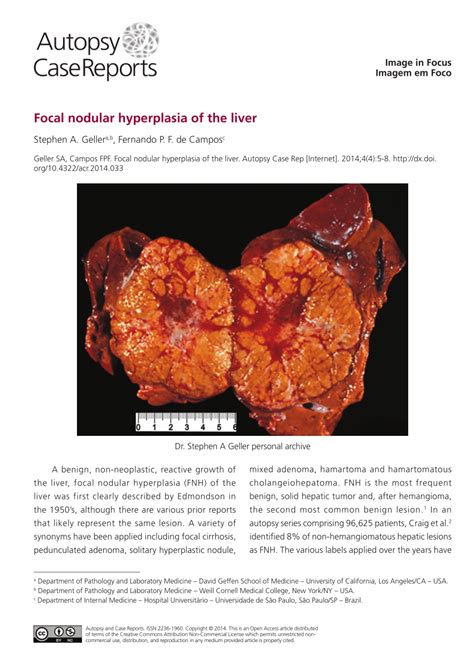 Nodular Hyperplasia Liver