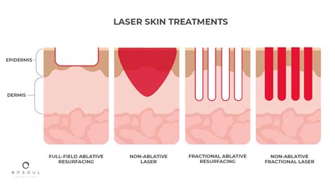 Non Ablative Fractional Laser