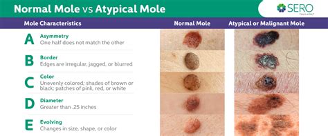 Non Cancerous Moles