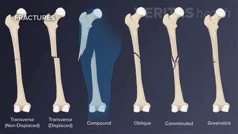 Non Displaced Fracture