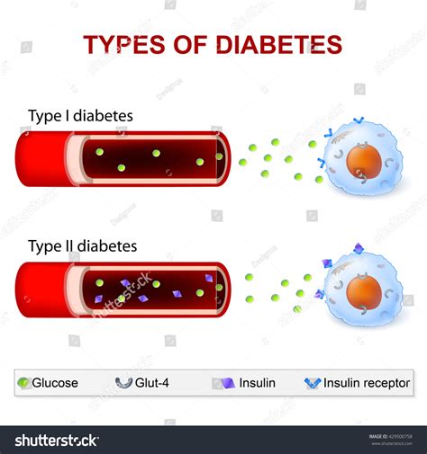 Non Insulin Dependent Diabetes Mellitus