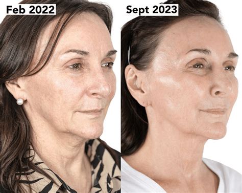 Non Surgical Facelift