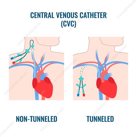 Nontunneled Cvc Catheter