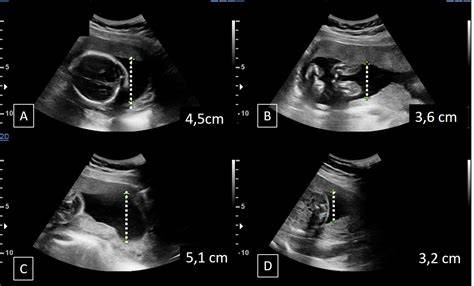 Normal Amniotic Index
