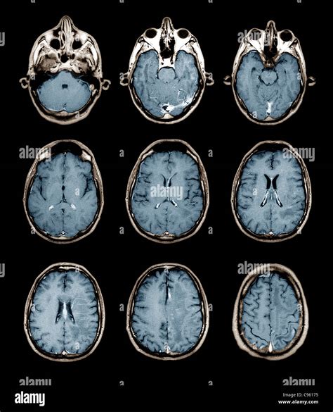 Normal Brain Mri