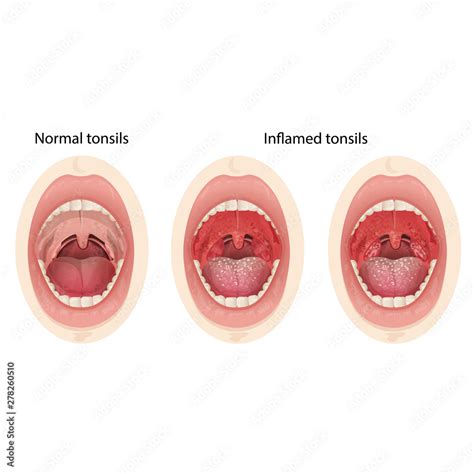 Normal Image Of Throat