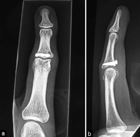 Normal Index Finger Xray