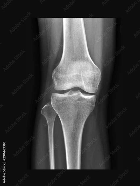 Normal Knee Xray
