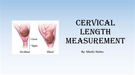 Normal Length Of The Cervix