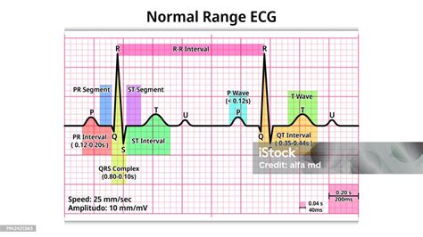 Normal Qt Wave