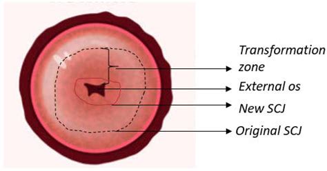 Normal Size Of A Cervix
