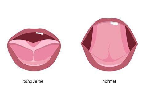 Normal Tongue Tied