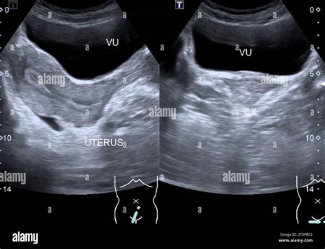 Normal Uterus Ultrasound