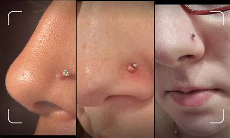 Nose Piercing Bump