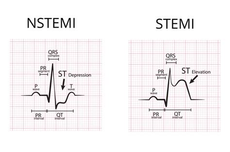 Nstemi Ekg